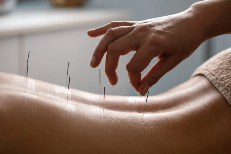 Acupuncture Therapy: Ancient Healing for Modern Pain and Stress Relief